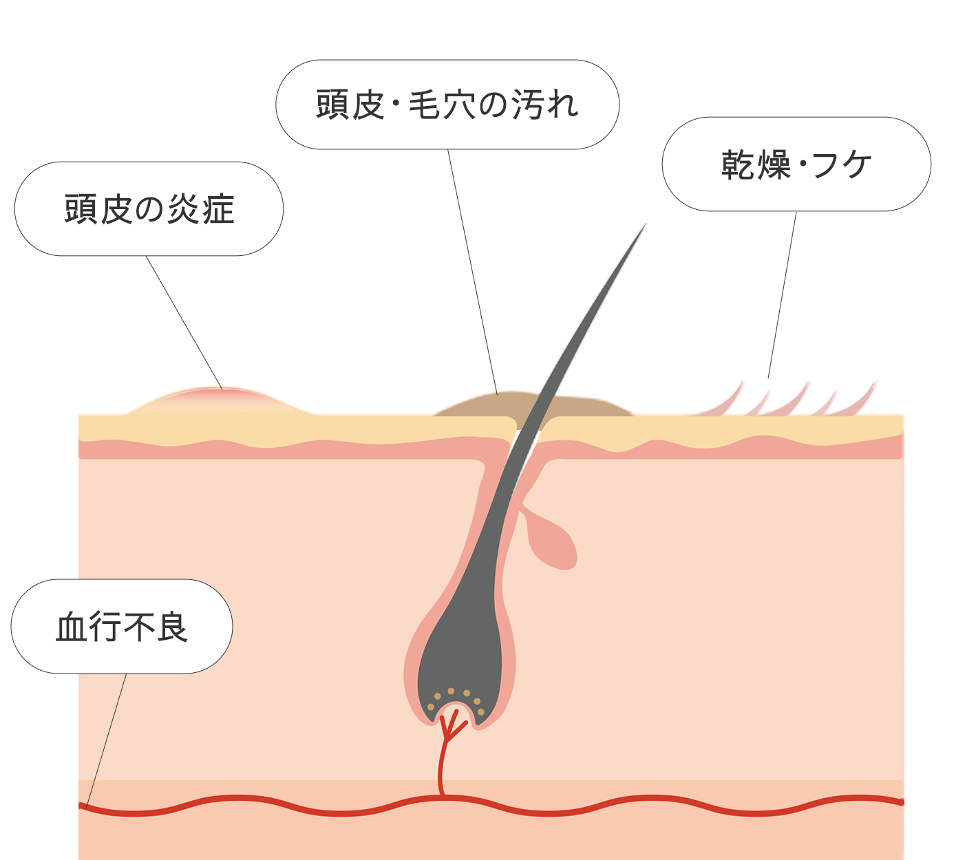 悪化した頭皮環境